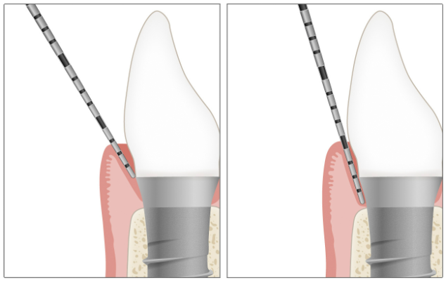 Minh họa implant với độ sâu túi 5 mm và bờ nướu 3 mm