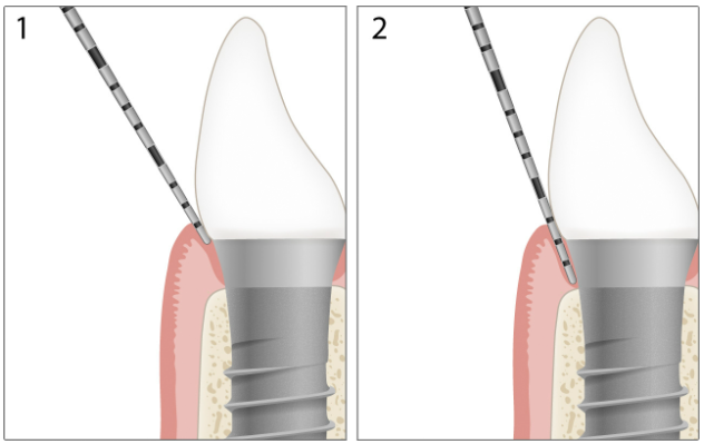 Minh họa implant với độ sâu túi 3 mm và bờ nướu 1 mm