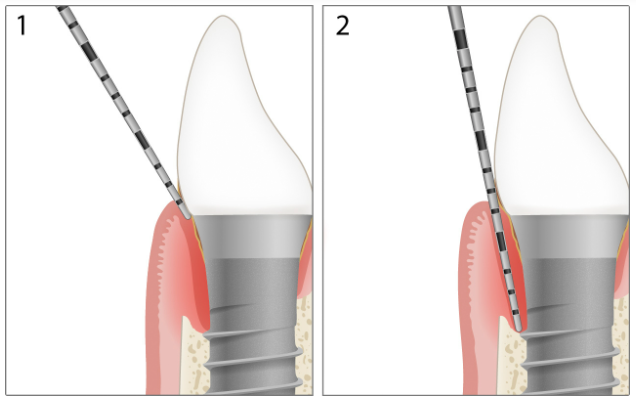 Minh họa implant với độ sâu túi 7 mm và bờ nướu 1 mm