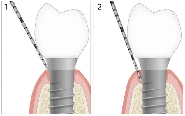 Minh họa tụt nướu quanh implant với độ sâu túi 2 mm và bờ nướu âm 2 mm