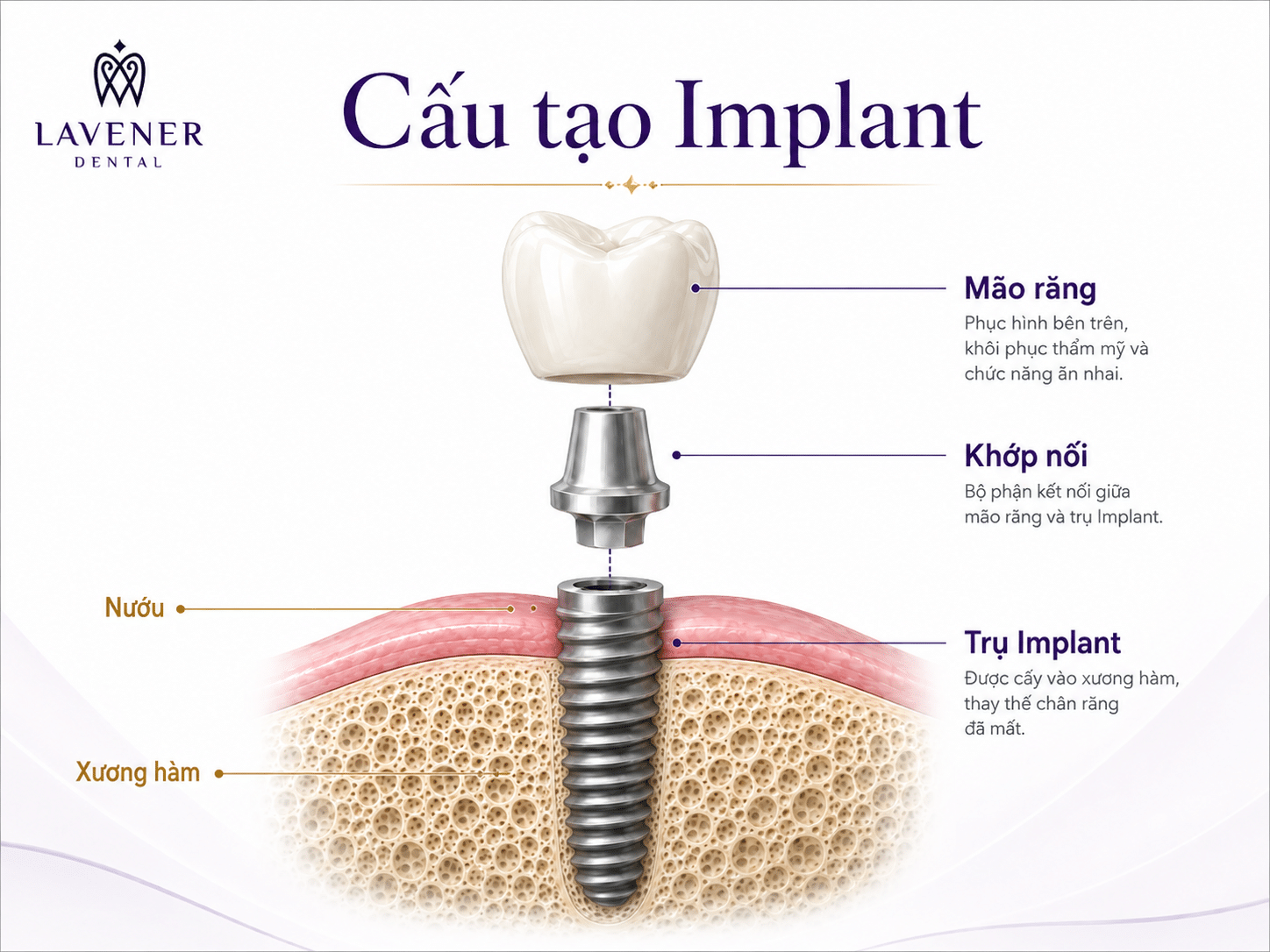 Sơ đồ cấu tạo Implant gồm mão răng, khớp nối và trụ Implant
